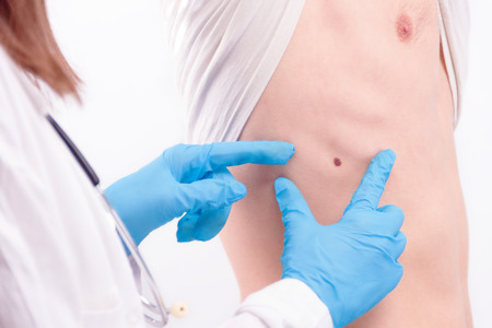 Oncological disease concept. Doctor wearing white coat and stethoscope in gloves examining melanoma on manâs skin.の写真素材