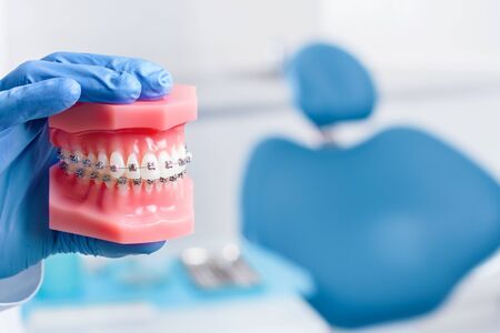 Closeup doctor male hand in gloves is holding jaw layout with metal braces. Blue dental chair with tools, instruments in clinic, office on background. Visit to dentist, orthodontist concept.の写真素材