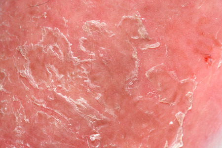 Psoriasis skin. Psoriasis is an autoimmune disease that affects the skin cause skin inflammation red...
