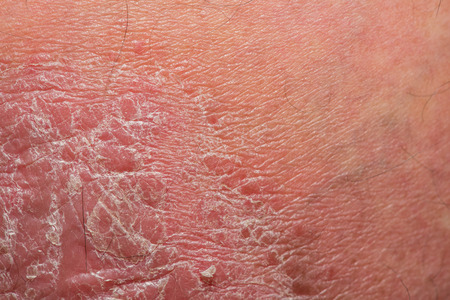 Psoriasis skin. Psoriasis is an autoimmune disease that affects the skin cause skin inflammation red and scaly.の写真素材