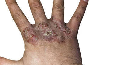 Close up of eczema or psoriasis on hand skin with open wounds, peel and crust isolated on white. Copy space.の写真素材