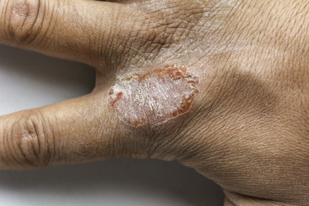 Close up of eczema or psoriasis on hand skin with open wounds peel and crust - Dermatitis conceptの写真素材