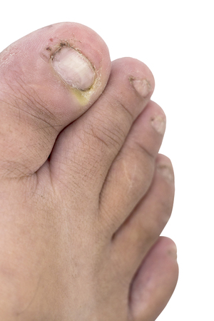 Fungus of foot close-up, isolated on white background. The concept dermatology, treatment fungal and fungal infections in humans. Macro photograph human parasites. Rear background of a dermatologist.の写真素材