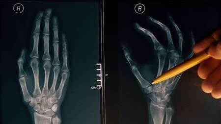 Doctor explains xray image of a hand to a patientの写真素材