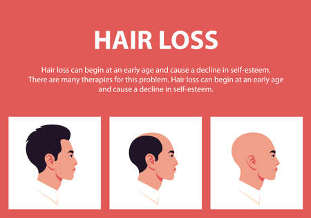 The stages of male pattern baldness. Hair loss. Alopecia. Profiles of Asian men. Vector flat illustrationのイラスト素材