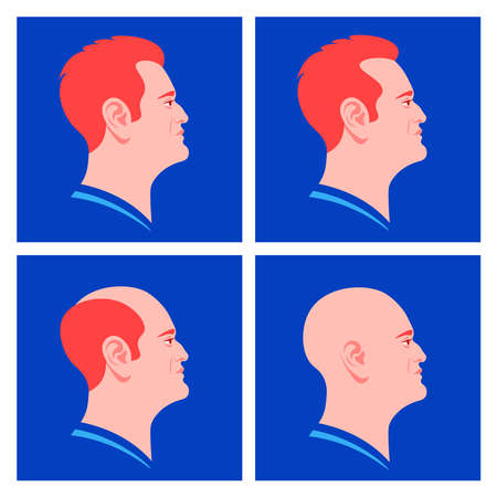 The stages of male pattern baldness. Hair loss. Alopecia. Profiles of European men. Vector flat...