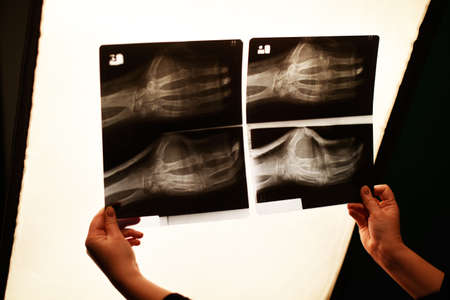 The nurse's hand is holding a x-ray photo of the arm. Arm fracture, medicine.の写真素材
