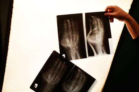 The nurse's hand is holding a x-ray photo of the arm. Arm fracture, medicine.の写真素材