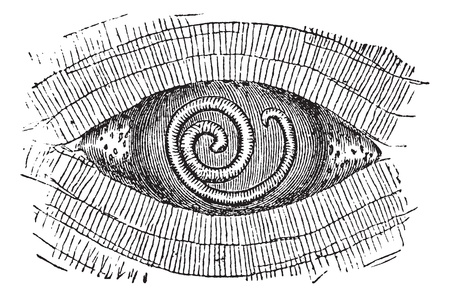 Pork Roundworm or Trichinella spiralis, showing larva found in between muscle fibers, vintage engraved illustration. Trousset encyclopedia (1886 - 1891).のイラスト素材