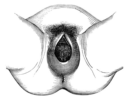 Perineal distention and dilation of the vulva, vintage engraved illustration. Magasin Pittoresque 1875.のイラスト素材