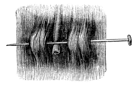 Acupressure with a single needle, vintage engraved illustration. Magasin Pittoresque 1875.のイラスト素材