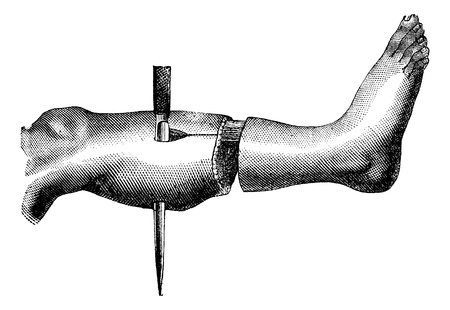 Amputation of the leg by the method has two flaps (formation of the second flap), vintage engraving  illustration. Magasin Pittoresque 1875.のイラスト素材