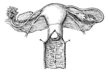 Internal genitals of women, vintage engraved illustration. Usual Medicine Dictionary - Paul Labarthe - 1885.のイラスト素材