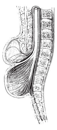 Cup anteroposterior spinal practiced on a spina bifida, vintage engraved illustration. Usual Medicine Dictionary by Dr Labarthe - 1885.のイラスト素材