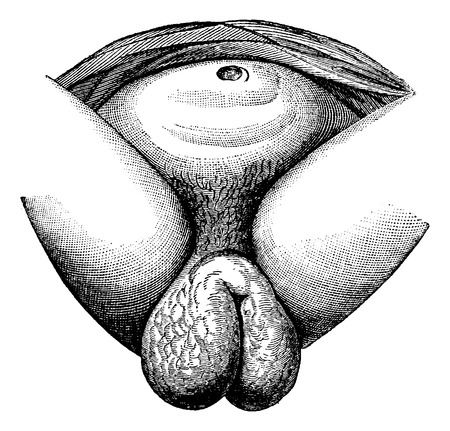 Elephantiasis of the labia majora in women observe a fellah, Cairo, vintage engraved illustration. Usual Medicine Dictionary - Paul Labarthe - 1885.のイラスト素材