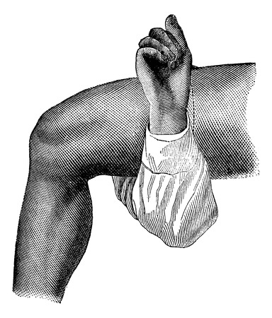 Amputation of the thigh by the circular method (skin incision), vintage engraving illustration. Magasin Pittoresque 1875.のイラスト素材