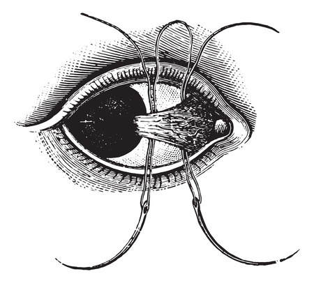 Ligation of pterygium, vintage engraved illustration. Usual Medicine Dictionary by Dr Labarthe - 1885.のイラスト素材