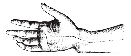 Fracture of the lower extremity of the radius. The figure shows the deformation Z member, vintage engraved illustration.Usual Medicine Dictionary by Dr Labarthe - 1885.のイラスト素材
