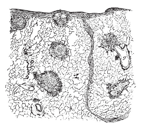 Section of lung showing chalicosis, vintage engraved illustration.のイラスト素材