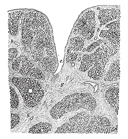 Syphilitic cirrhosis of the liver, vintage engraved illustration.のイラスト素材