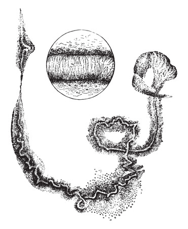 Curschmann's spirals, vintage engraved illustration.のイラスト素材