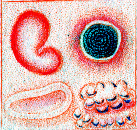 Syphilitic characters, vintage engraved illustration.の写真素材