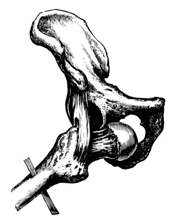This illustration represents Thyroid Dislocation of the Hip, vintage line drawing or engraving illustration.のイラスト素材