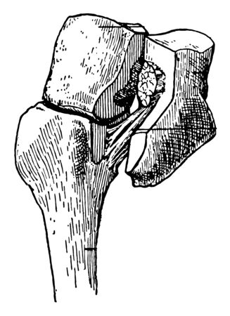 This diagram represents Ligament of Lisfranc, vintage line drawing or engraving illustration.のイラスト素材
