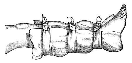 A typical representation to show how a pillow, an inside coat, a sweater, or a blanket may be used as a temporary splint on a broken leg, vintage line drawing or engraving illustration.のイラスト素材