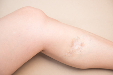 scars on leg wound from missile, bodyの写真素材
