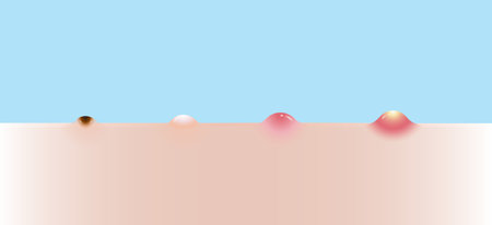 Types of acne vector set illustration isolated on sky blue background. Formation of acne, blackhead, whitehead, papule and pustule. Flat design vector acne illustration.のイラスト素材