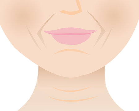 The lower face wrinkled skin of mature woman vector illustration. Marionette lines, Nasolabial folds, Smile lines, Mental crease and Neck lines. Deep aging wrinkles on face.のイラスト素材