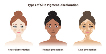 Types of skin pigment discoloration vector on white background. Hyperpigmentation, darkened pigment. Hypopigmentation, lightened pigment. Depigmentation, loss of pigment.のイラスト素材