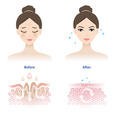 Comparison of woman face before and after wrinkle skincare absorption illustration on white background. Cross section of wrinkles skin and skincare absorbing to help reduce aging and damaged skin.のイラスト素材