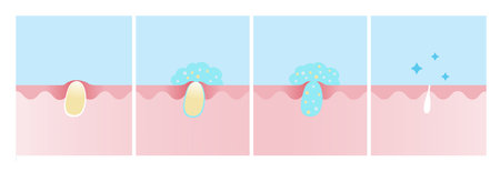 Step of acne pimple treatment process vector illustration. Apply salicylic acid on whitehead, penetrate into skin to dissolve closed plugged pore the dead skin cell, excess oil and keeping pore clear.のイラスト素材