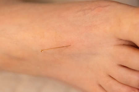 A portrait of a thin acupuncture needle on top of the foot, put in place by an acupuncturist. This alternative medicine treatment is used for healing, stimulation, relaxing and stress relief.の写真素材