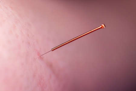 A small acupuncture needle sticking into the skin of a patient. The needle has a copper grip and is punctured deep into the skin to heal pain and to relieve stress or other medical condition.の写真素材