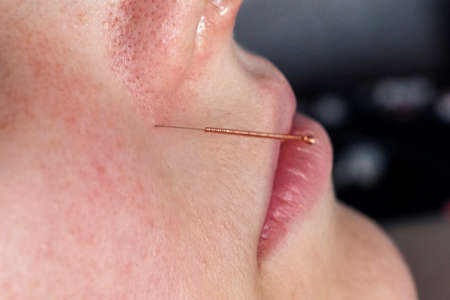 A close up portrait of a small acupuncture needle sticking in a person's face next to the nose, to...