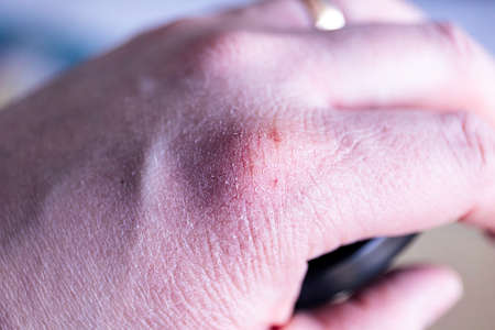 A portrait of a hand with dry skin with some painful fissures in it. The cracked skin should be treated with some moisturizing ointment or cream to prevent it from more rips.の写真素材