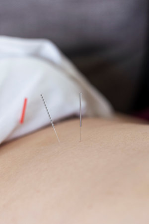 A close up portrait of an acupuncture needle sticking into a persons skin and body to heal or relax....