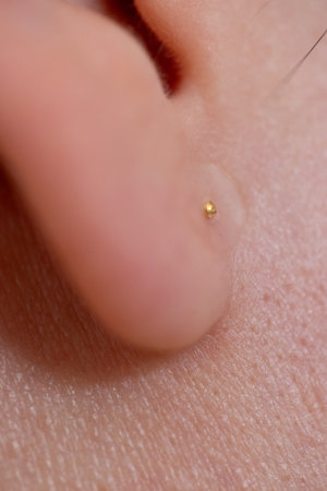 Alternative healing method shown in close-up: acupressure seeds on earlobe used to relieve stress, promote relaxation, and enhance energy flow.の写真素材