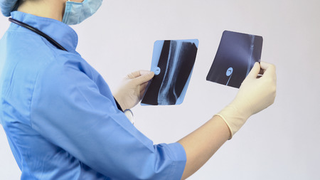 Doctor analyzing injured bones x-ray, making diagnosis, hospital surgery, job, stock footage