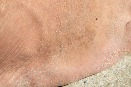 close up of dried and dead feet skin Foot peeling