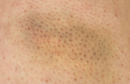 Large bruise hematoma on the humans leg on the skin in different colors