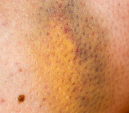 Large bruise hematoma on the humans leg on the skin in different colorsの写真素材