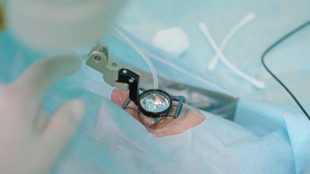 Hands of ophtalmology surgeons and assistants with ophtalomological surgery tools during surgical treatment. Indoor. Medium.の写真素材