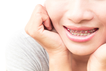 Close up woman smiling with Ceramic and Metal Braces on white background, beauty and healthy conceptの写真素材