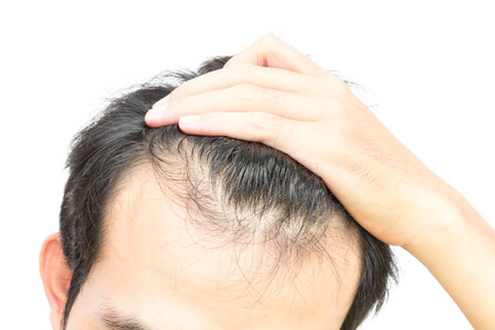 Closeup young man serious hair loss problem for hair loss concept or health care shampoo product on...