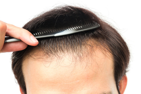 Closeup young man serious hair loss problem for hair loss concept