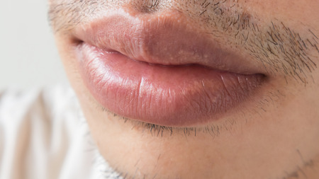 Closeup of lips man problem health care, Herpes simplexの写真素材